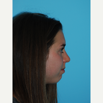 24 year old woman 1 month after rhinoplasty after 3140085