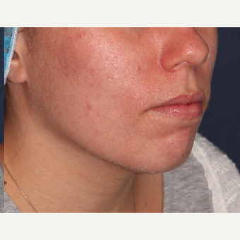 18-24 year old woman treated with V Beam after 3149503