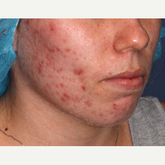 18-24 year old woman treated with V Beam before 3149503