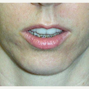 45-54 year old woman treated with Chin Surgery 1775161