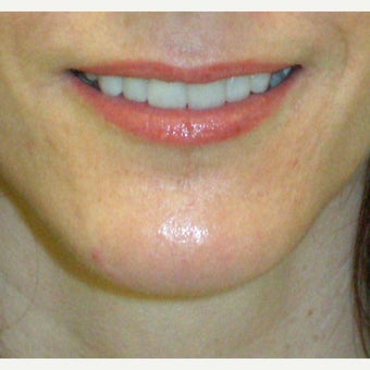 45-54 year old woman treated with Chin Surgery 1775161