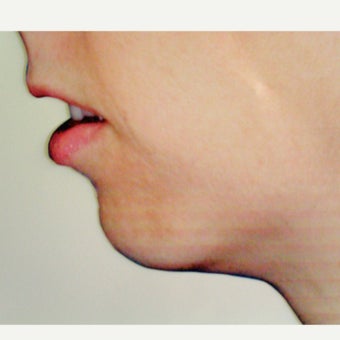 45-54 year old woman treated with Chin Surgery before 1775161