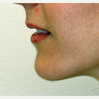 45-54 year old woman treated with Chin Surgery after 1775161