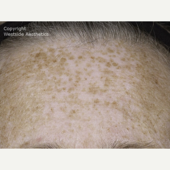 Fraxel for Sun Damage on Forehead before 3065389
