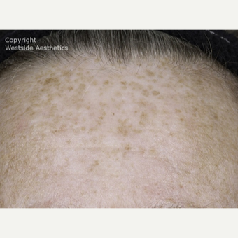 Fraxel for Sun Damage on Forehead after 3065389