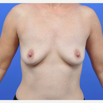 35-44 year old woman treated with Breast Augmentation before 3091330