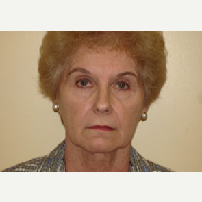 65-74 year old woman treated with Mini Lift and Fraxel Laser before 3264805