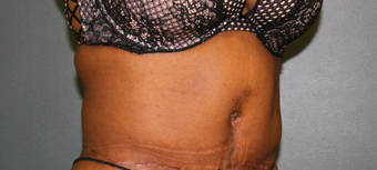 35-44 year old woman treated with Tummy Tuck after 2556196