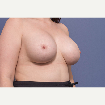 25-34 year old woman treated with Breast Lift with Implants after 3728891