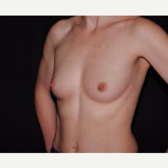 25-34 year old woman treated with Breast Implants before 3593672