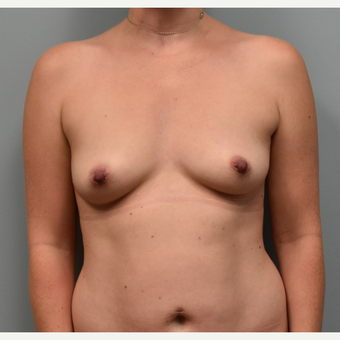 35-44 year old woman treated with Breast Augmentation before 3384898