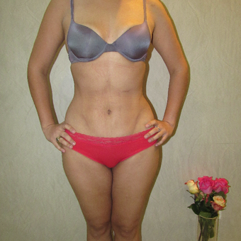 25-34 year old woman treated with Liposculpture after 2815069