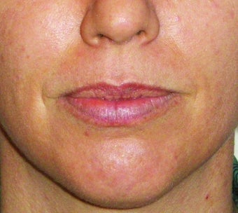 Filler for Lip Augmentation before 123683