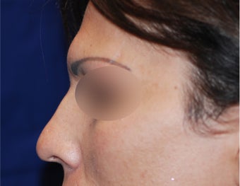 Endoscopic Brow Reduction before 1378858