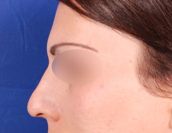 Endoscopic Brow Reduction after 1378858