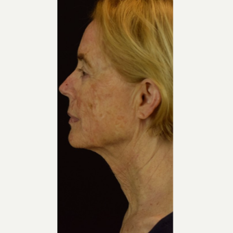 45-54 year old woman treated with Halo Laser before 3202874