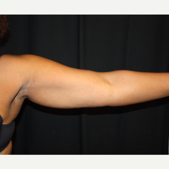 45-54 year old woman treated with CoolSculpting before 3169476