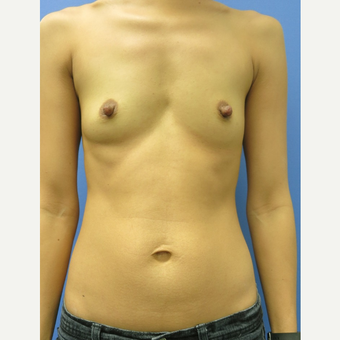 25-34 year old woman treated with Breast Augmentation before 3421999
