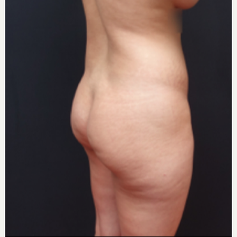 25-34 year old woman treated with Butt Augmentation before 3267012
