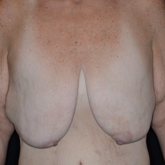45-54 year old woman treated with Breast Reduction before 3810462