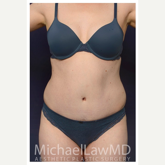 35-44 year old woman treated with Tummy Tuck after 3174253