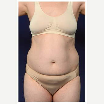 35-44 year old woman treated with Tummy Tuck before 3174253