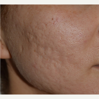 25-34 year old woman treated with Acne Scars Treatment before 3642144