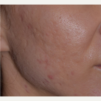 25-34 year old woman treated with Acne Scars Treatment after 3642144