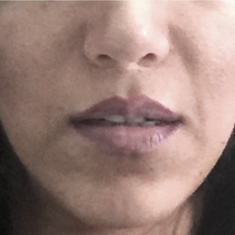 35-44 year old woman treated with Lip Lift after 3006133