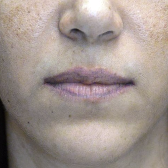 35-44 year old woman treated with Lip Lift before 3006133
