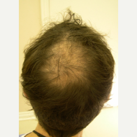 42 year old man treated with FUE Hair Transplant before 3724536