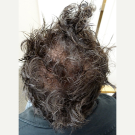 42 year old man treated with FUE Hair Transplant after 3724536
