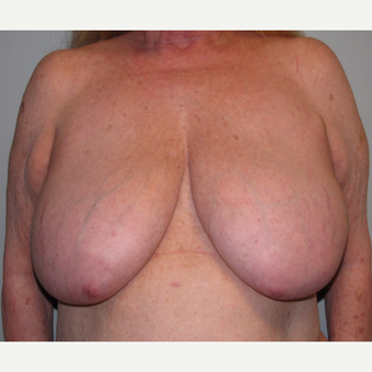 55-64 year old woman treated with Breast Reduction before 3175197
