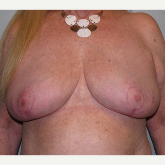 55-64 year old woman treated with Breast Reduction after 3175197