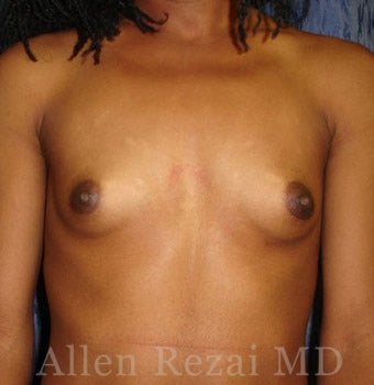 Bilateral Breast Augmentation - Patient has type I-II Tuberous Breast Deformity - Pre- & 13 Months Post-op before 2255559