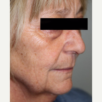 55-64 year old woman treated with Facelift before 2878108