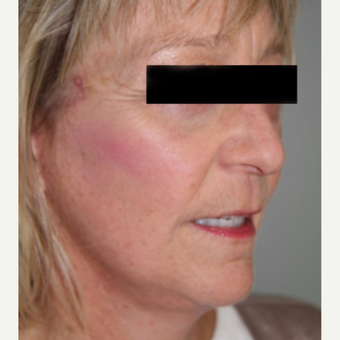 55-64 year old woman treated with Facelift after 2878108