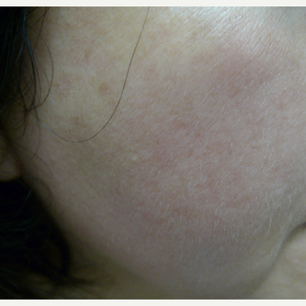 10 weeks to better skin texture and pigmentation reduction after 3114388