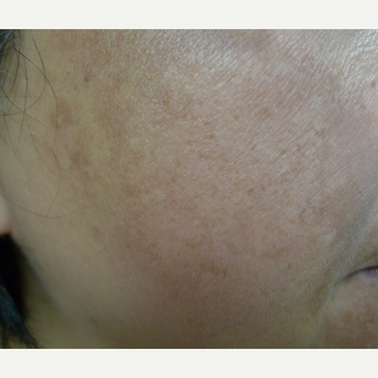 10 weeks to better skin texture and pigmentation reduction before 3114388