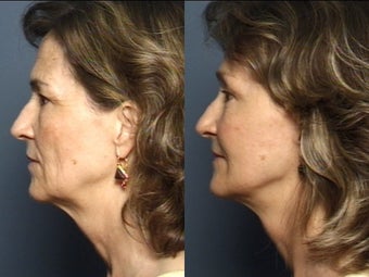Facelift, Brow Lift & Lower Eyelid Surgery 337408