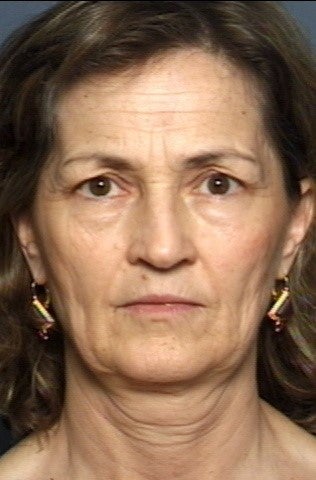 Facelift, Brow Lift & Lower Eyelid Surgery before 337408