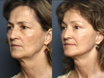 Facelift, Brow Lift & Lower Eyelid Surgery 337408