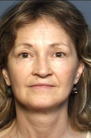 Facelift, Brow Lift & Lower Eyelid Surgery after 337408