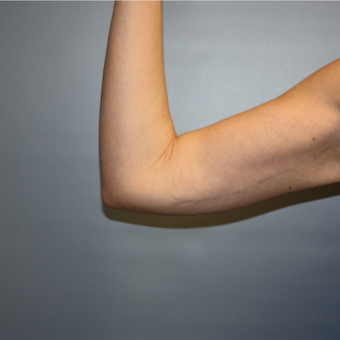 35-44 year old woman treated with Arm Lift after 3808286