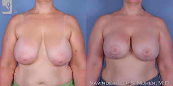 45-54 year old man treated with Breast Lift with Implants before 3767729