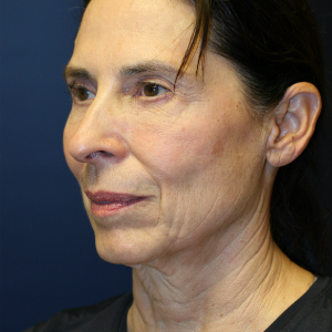 64 year old woman treated with Neck Lift before 3554103