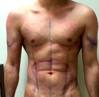25-34 year old man treated with Vaser Liposuction after 2048197