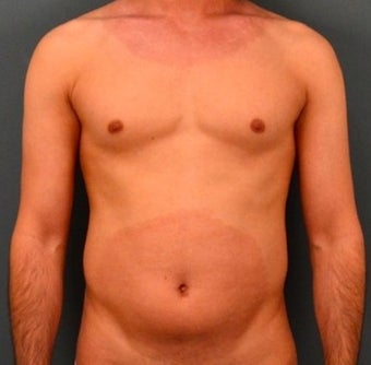 25-34 year old man treated with Vaser Liposuction before 2048197