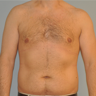 25-34 year old man treated with Male Breast Reduction after 3125521