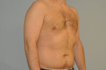 25-34 year old man treated with Male Breast Reduction 3125521